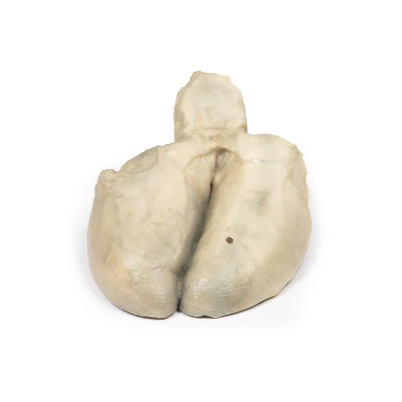 3D Printed Cholecystitis and Cholelithiasis