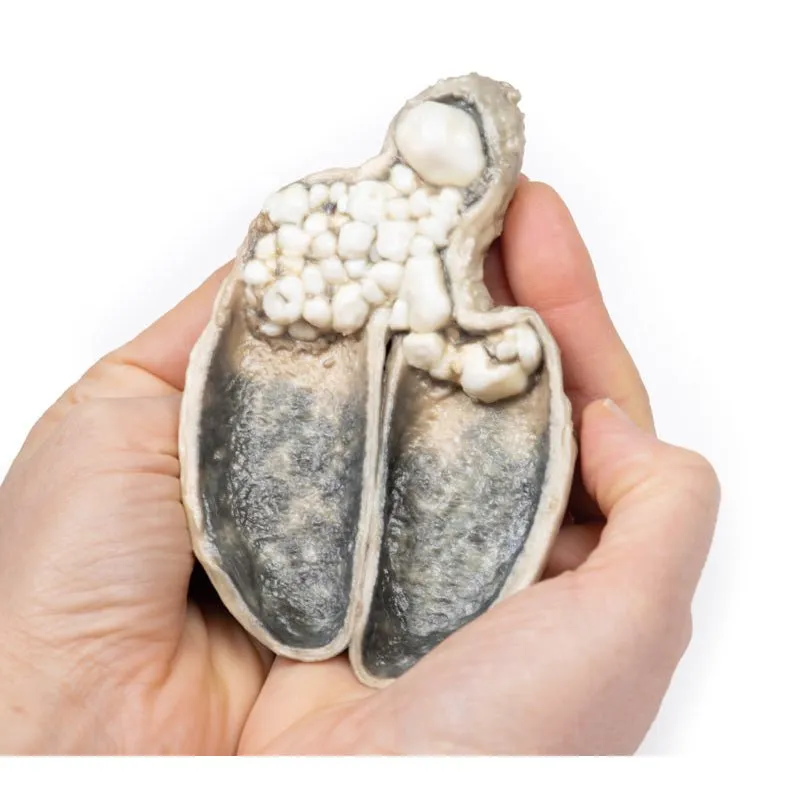 3D Printed Cholecystitis and Cholelithiasis