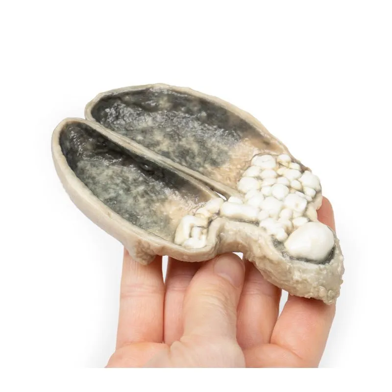 3D Printed Cholecystitis and Cholelithiasis