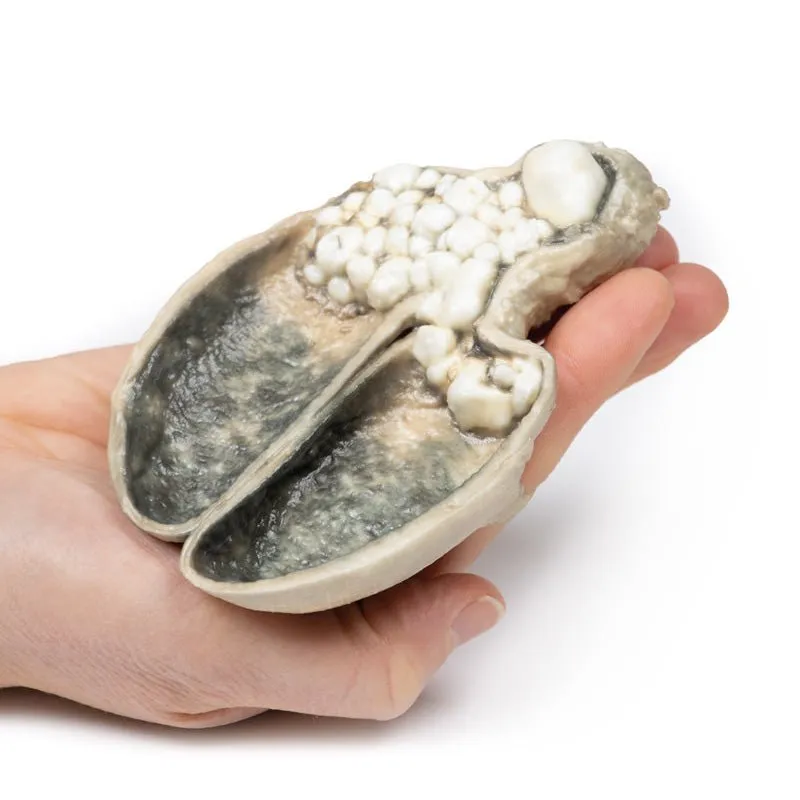 3D Printed Cholecystitis and Cholelithiasis